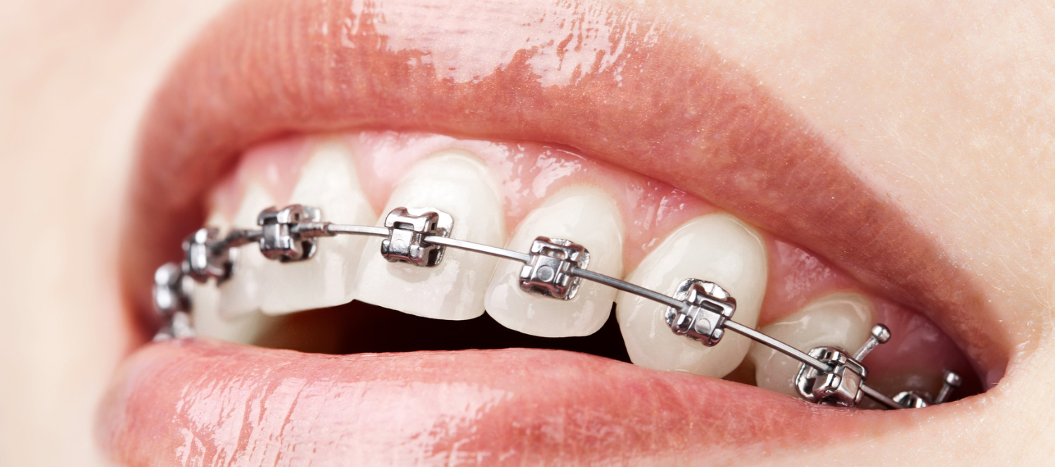 Orthodontics. 