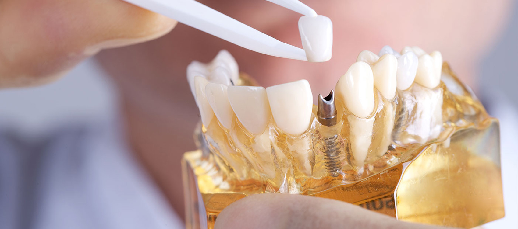 Dr Stajčić - Implantologija.